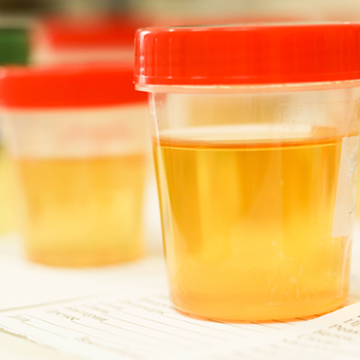 Proteína en la orina, causas y examen